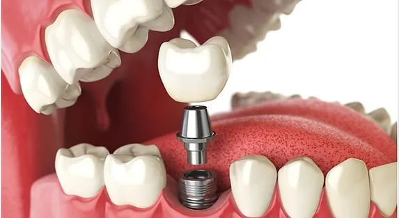 Tooth Implant Singapore