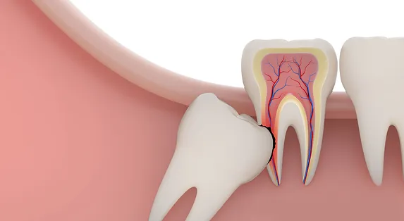Wisdom Tooth Removal Cost Singapore